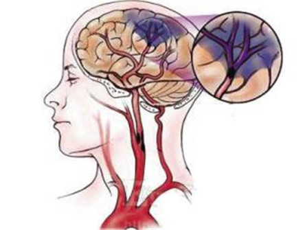 什么是脑血栓？的主要病因是什么？治疗